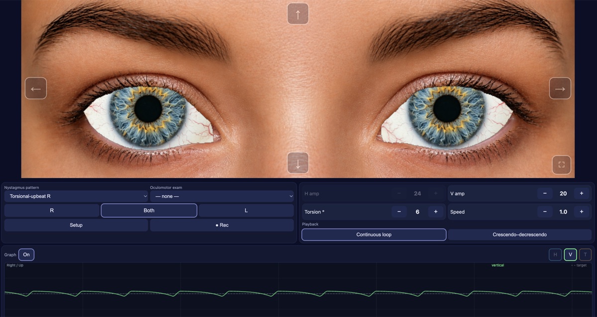 nystagmus.io app showing the torsional-upbeat nystagmus simulation with adjustable amplitude, torsion, and speed controls, plus a live eye-position graph